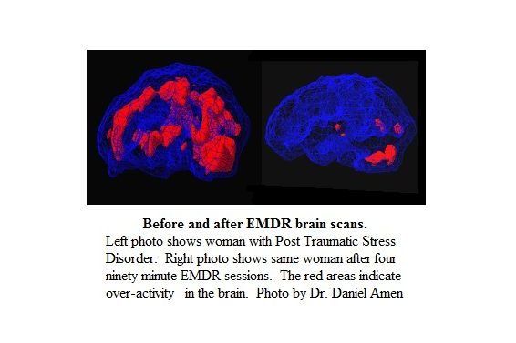 EMDR therapy counseling for trauma